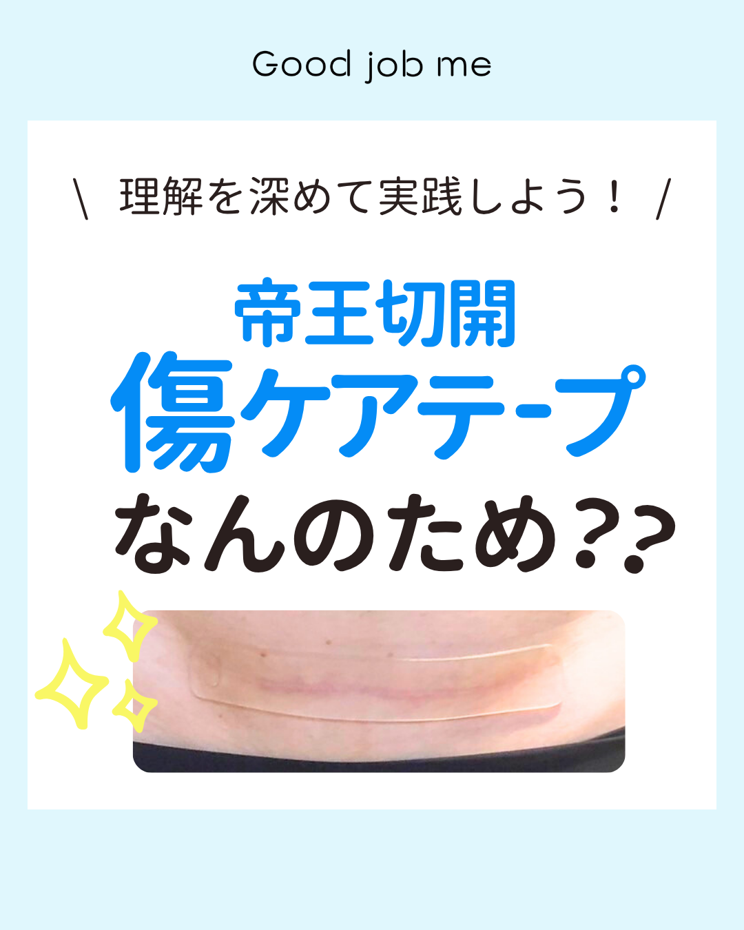 帝王切開後の傷あとケアテープの目的を解説。傷の保護・乾燥防止・皮膚の伸展防止などの役割と正しい使い方をイラスト付きで紹介。