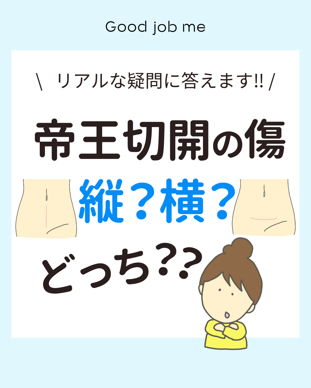 帝王切開の傷は縦?横?切り方の違いをイラストで解説。縦切開・横切開それぞれの特徴、メリット・デメリット、逆T字になるケース、2回目以降の帝王切開や地域差までわかりやすくまとめた図解