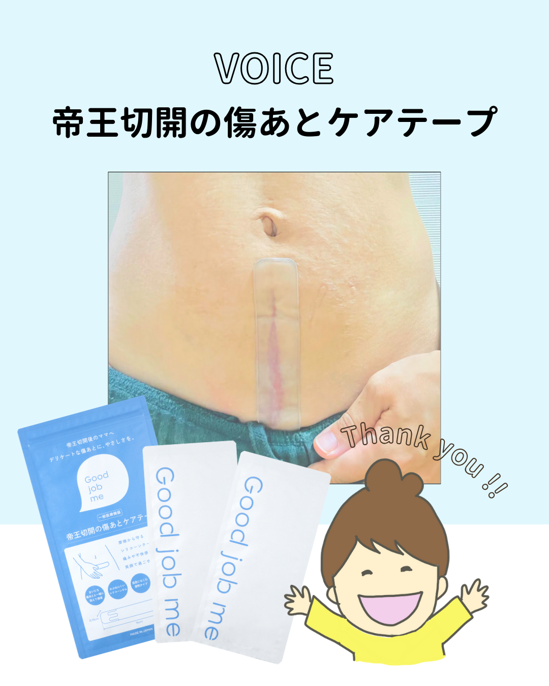 帝王切開の縦切開の傷あとにGood job meのシリコーンケアテープを貼った様子と製品パッケージ、利用者レビュー