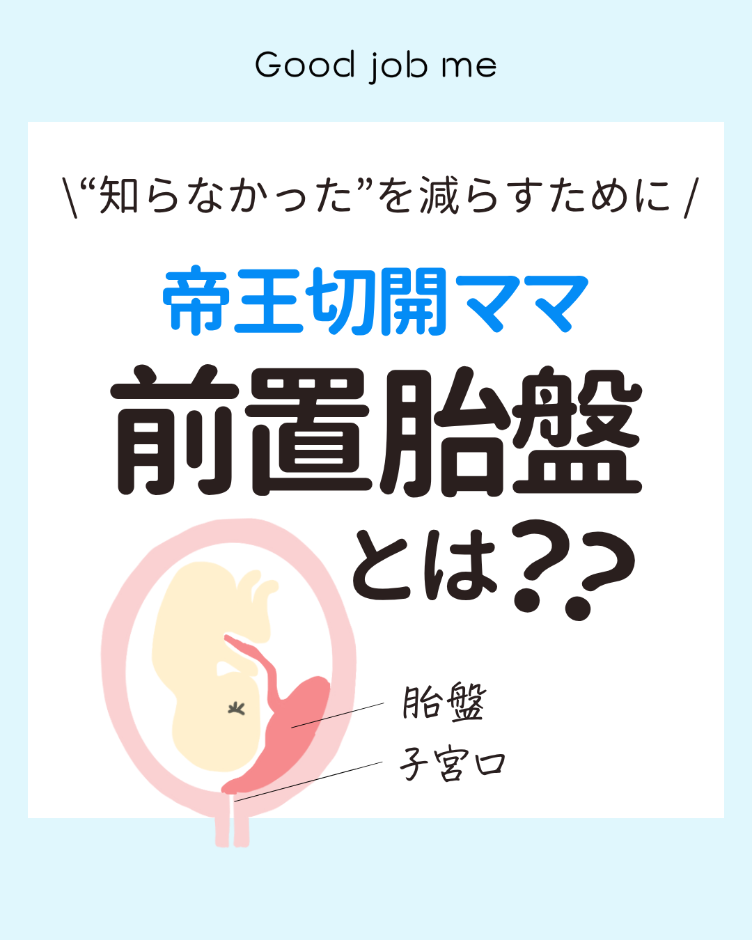 妊婦さん向けに「前置胎盤」について解説したInstagramカルーセル投稿。前置胎盤・低置胎盤の違い、種類、症状、帝王切開との関係、胎盤の位置が変わる可能性などをイラスト付きでわかりやすく紹介。