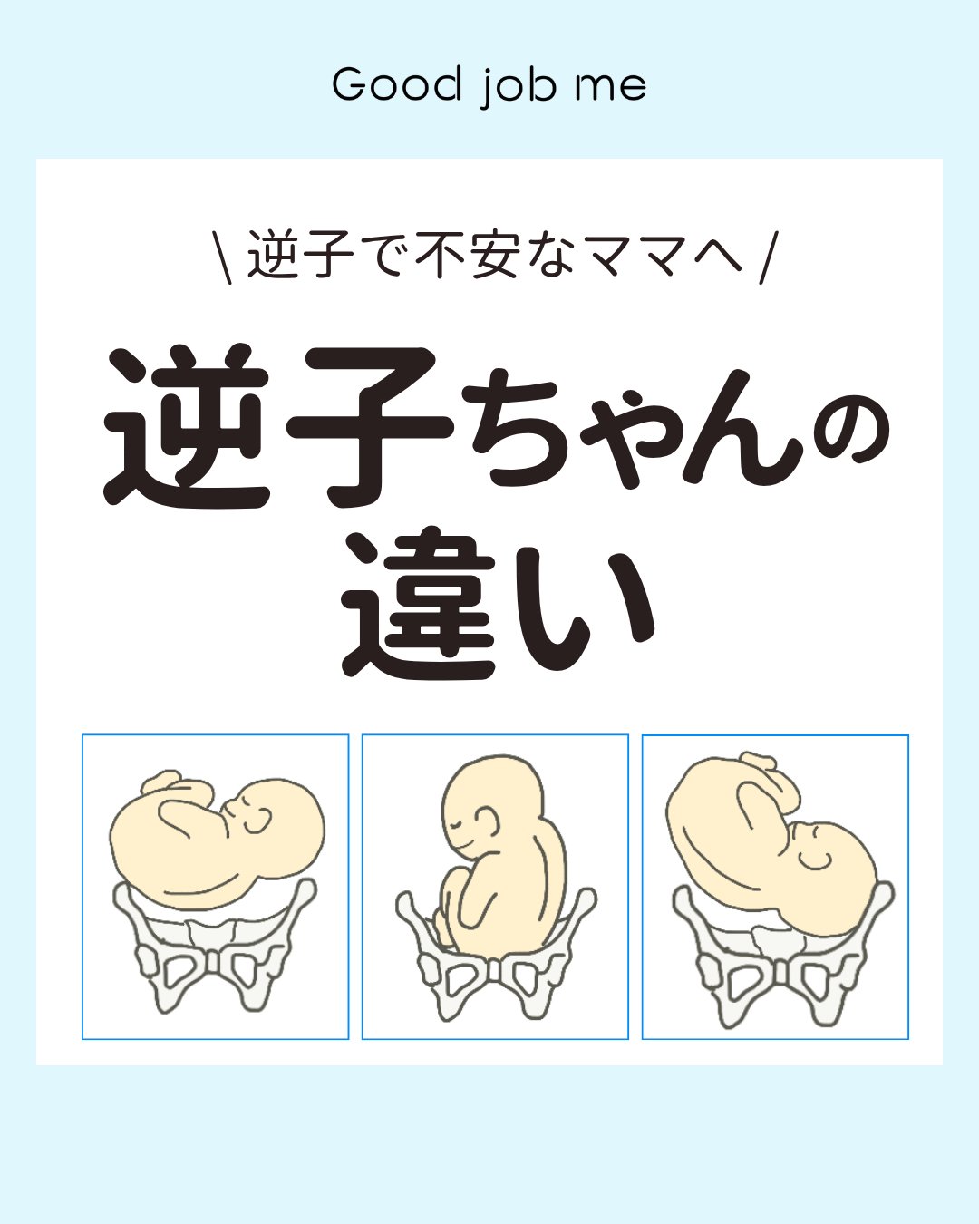 妊婦健診で「逆子」と言われた妊婦さん向けに、逆子の種類を解説した投稿。頭位と逆子の違い、骨盤位・横位・斜位などの姿勢をイラスト付きで紹介し、逆子になる確率や帝王切開との関係についてわかりやすく説明している。