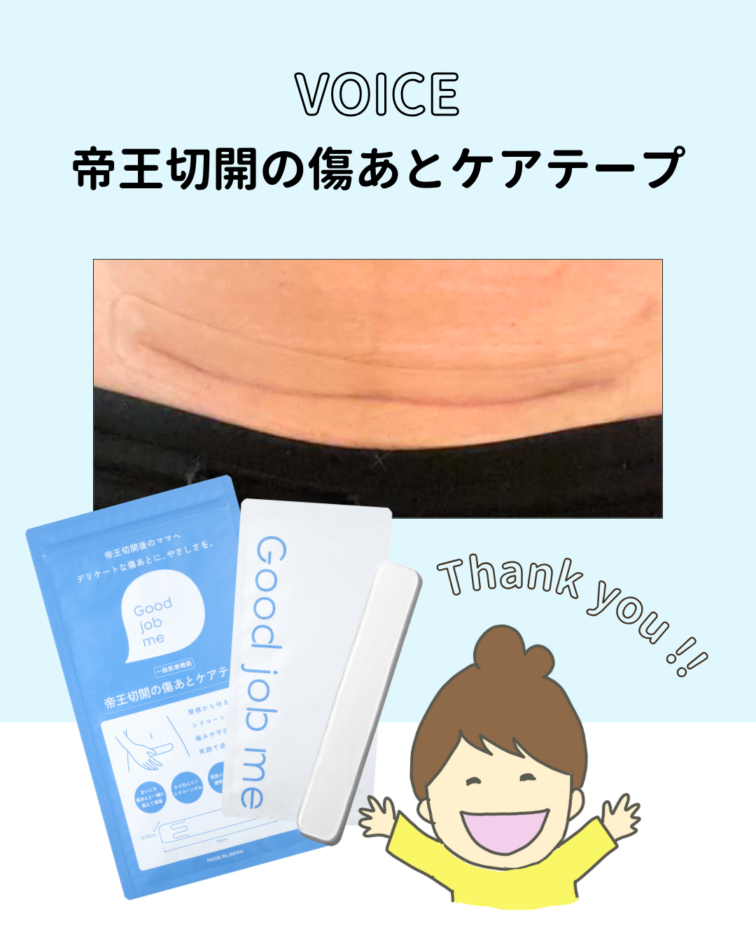 帝王切開の傷あとビフォーアフター｜『私には合っていた！』お客様のリアルなお声　Good job me