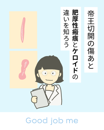 帝王切開の肥厚性瘢痕とケロイドの違い｜原因・予防・治療法を知ろう