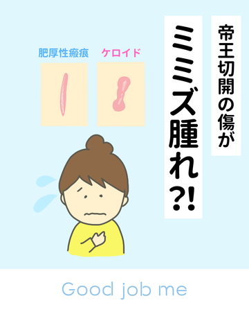 帝王切開の傷がミミズ腫れ!?その理由と対策をまとめました|Good job me