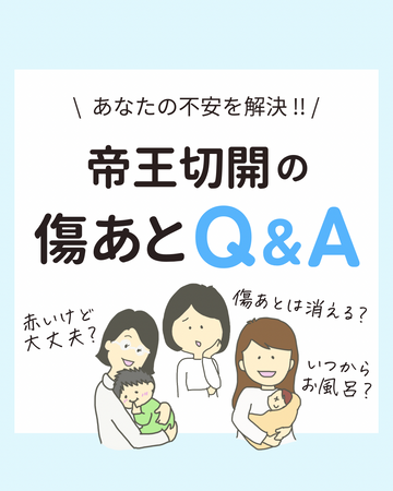 あなたの悩みを解決！帝王切開後の傷あとQ&A