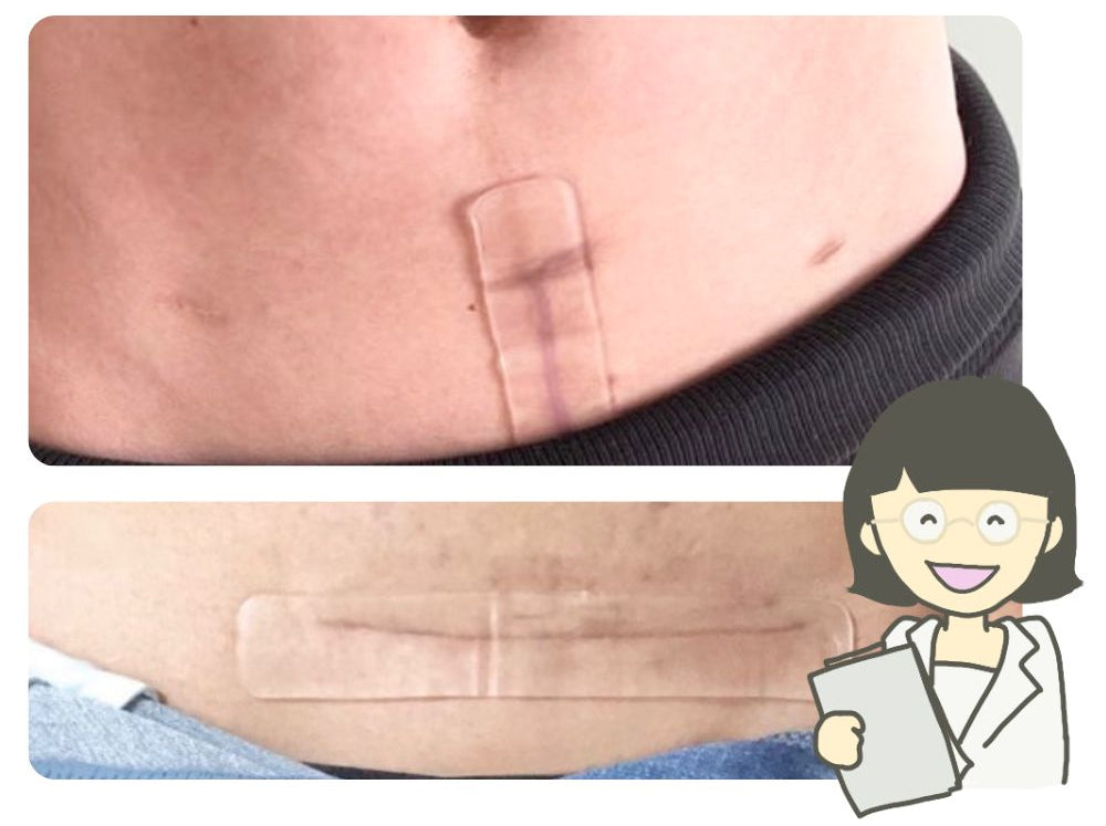 Good job me｜グッジョブミー 帝王切開の傷あとケアテープ